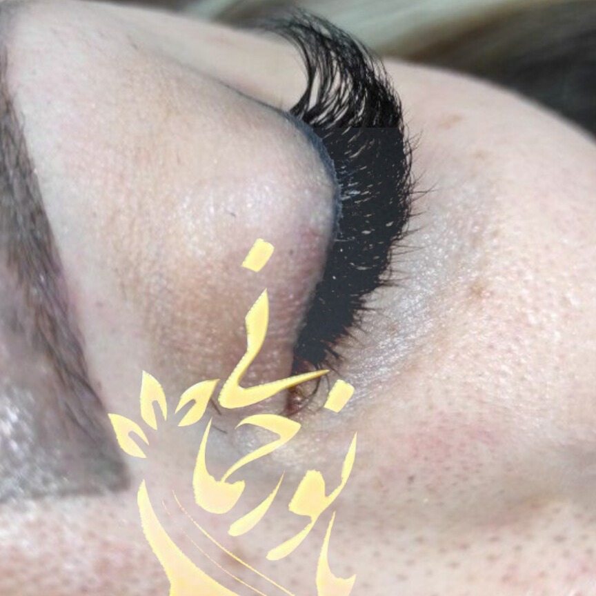 کاشت مژه